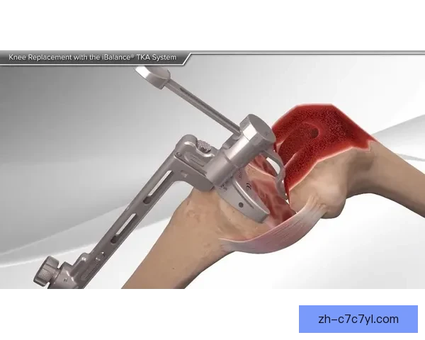 万幸！髌腱撕裂手术可恢复膝关节